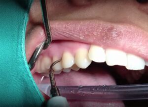 ขูดหินปูน