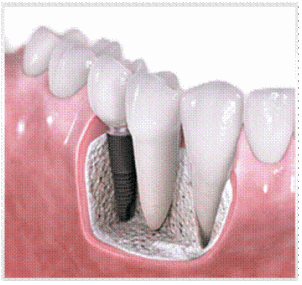 รากเทียม