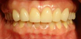 วีเนียร์